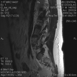 t2_tse_rst_sag0002