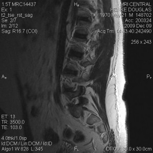 t2_tse_rst_sag0003