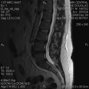 t2_tse_rst_sag0008